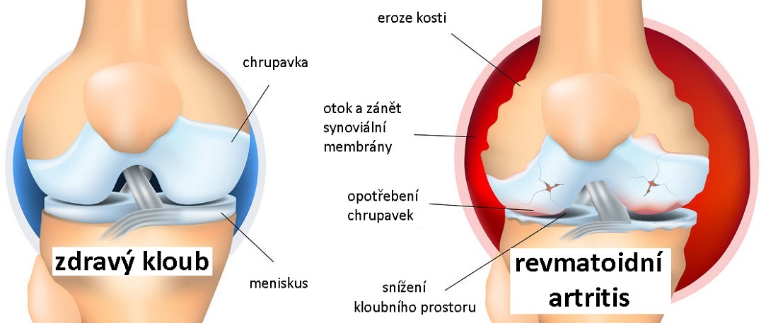 Rheumatoid-Arthritis2_1083
